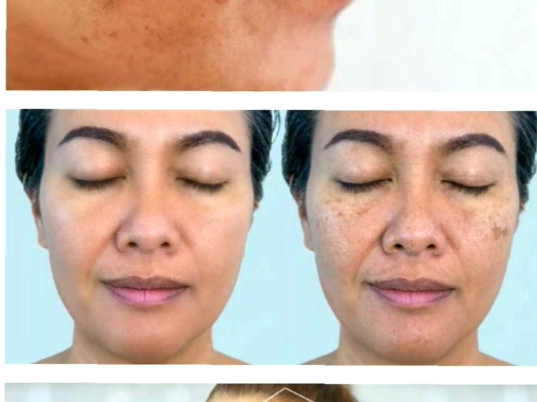 Advanced Techniques for Pigmentation Removal