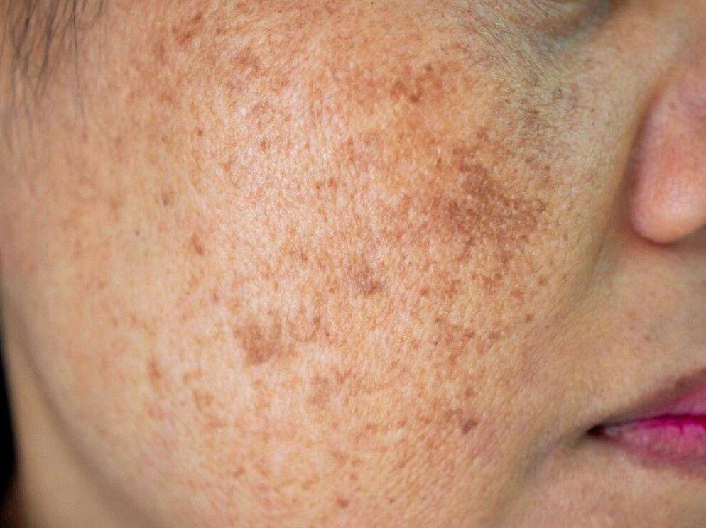 Expert Solutions for Treating Pigmentation Issues