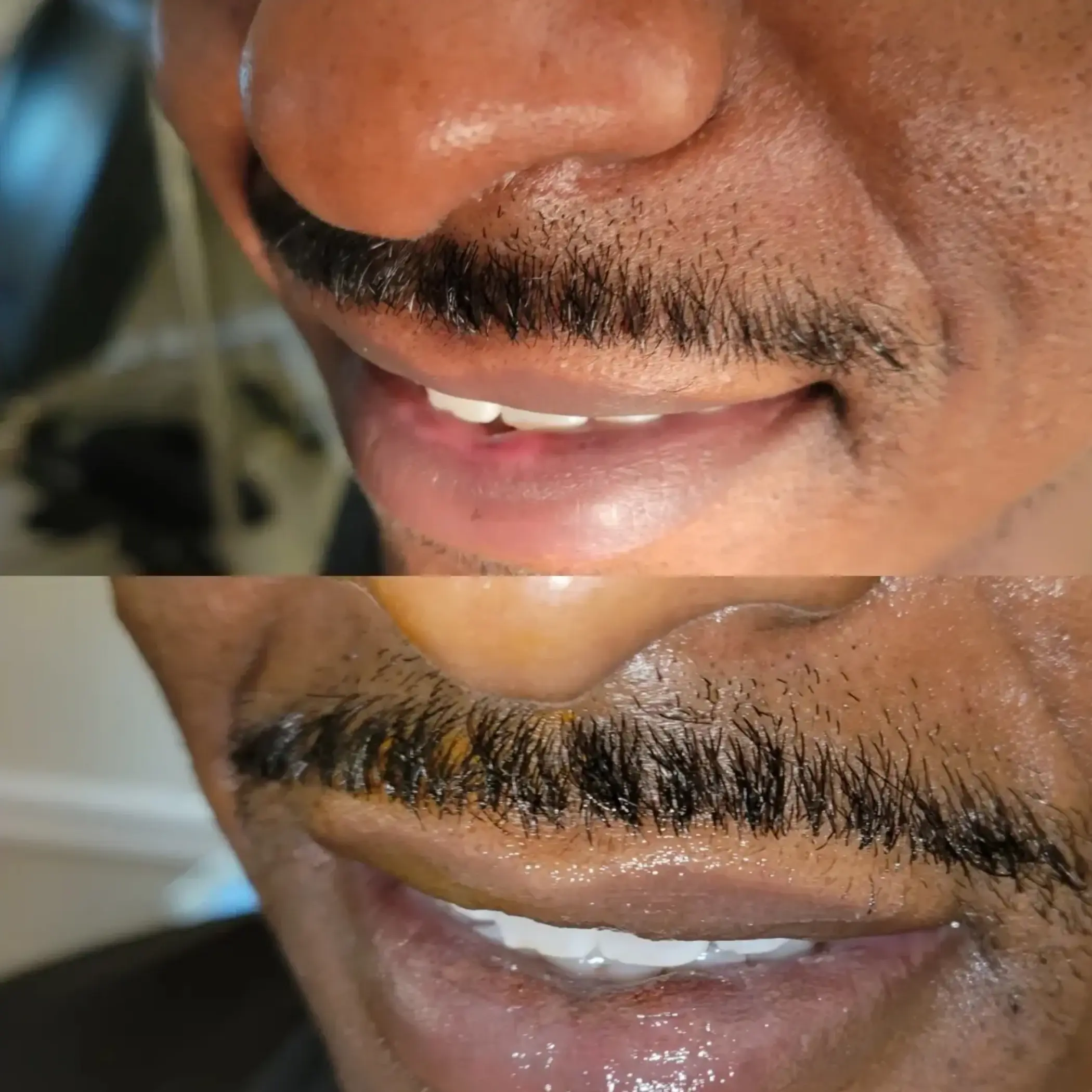 close up lip swelling after filler injection
