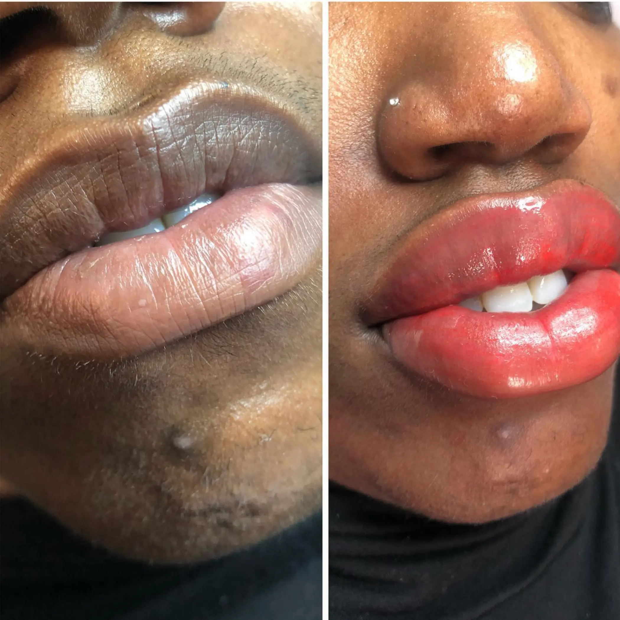 close up upper lip with fresh tattoo pigment
