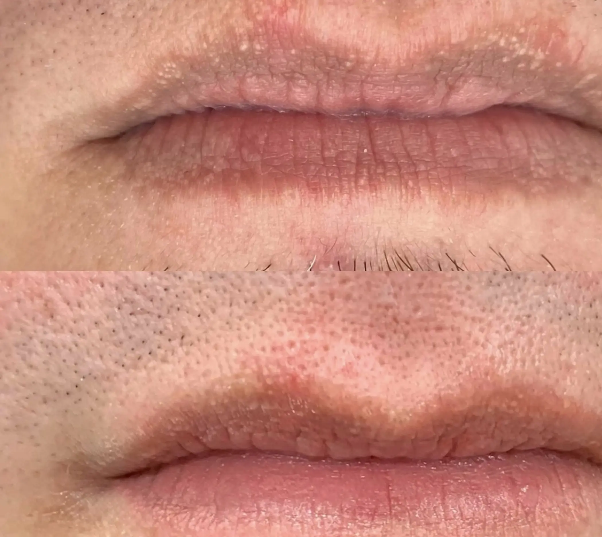 cosmetic tattoo artist working on lips