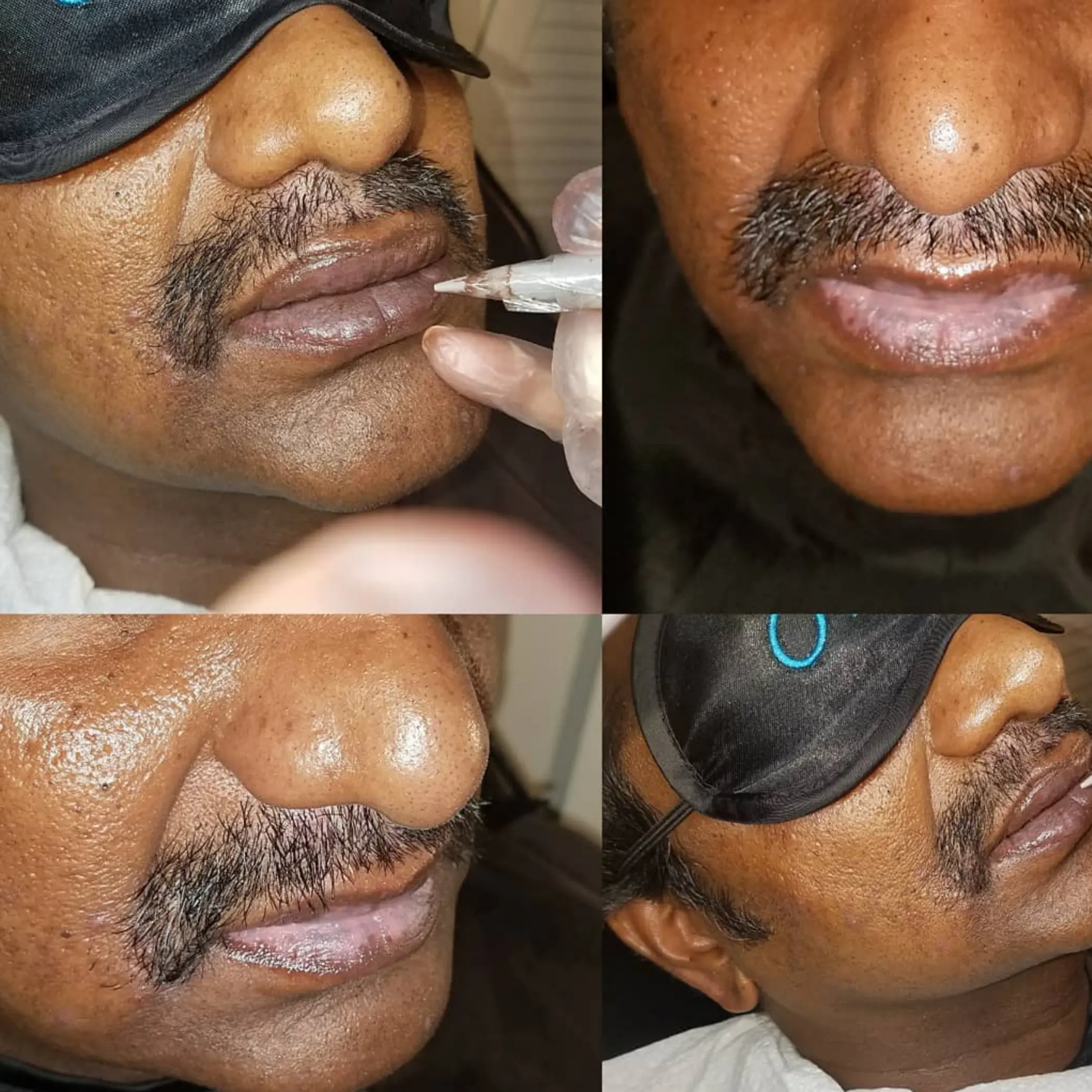 cosmetic tattooist applying lips permanent makeup