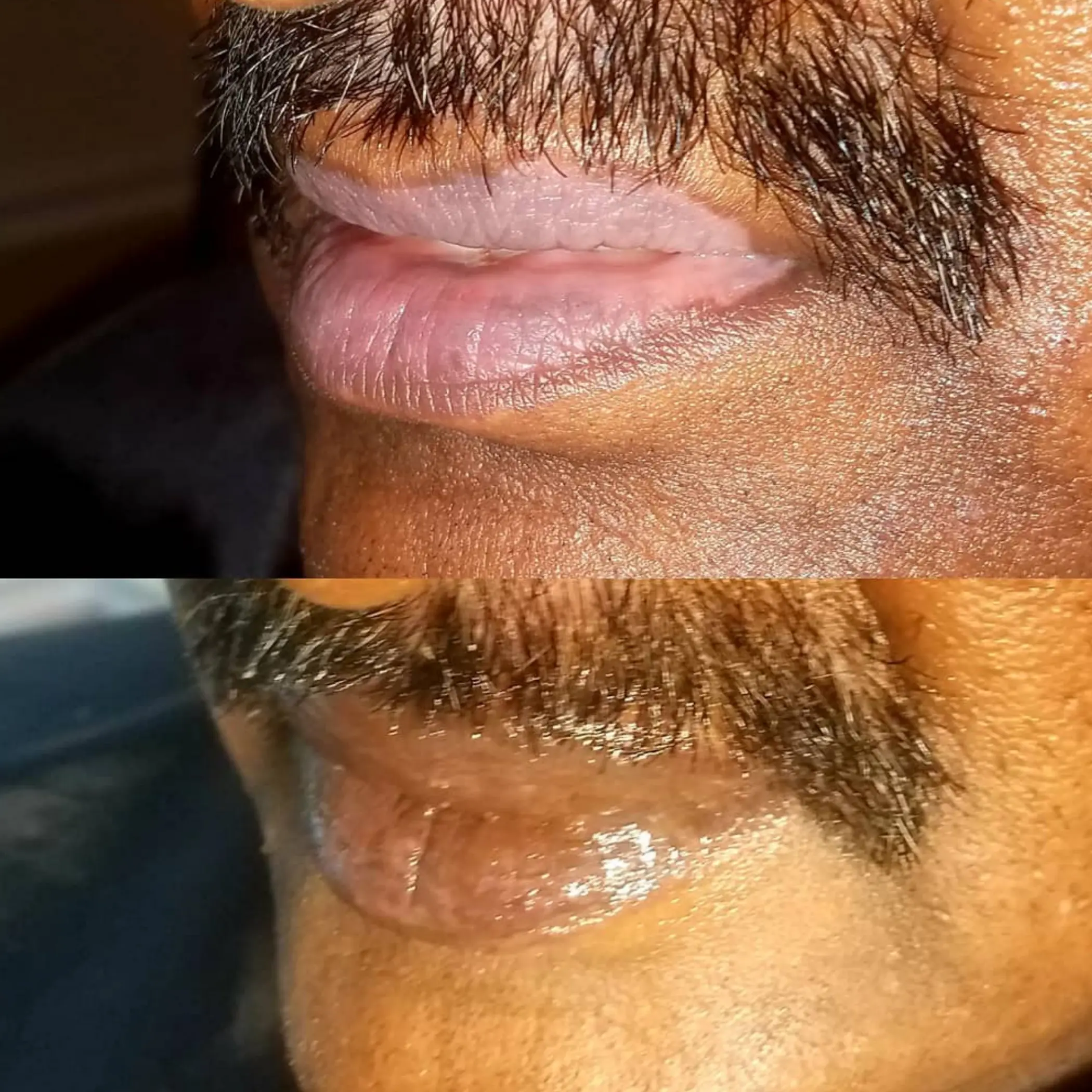 day by day lip filler healing stages