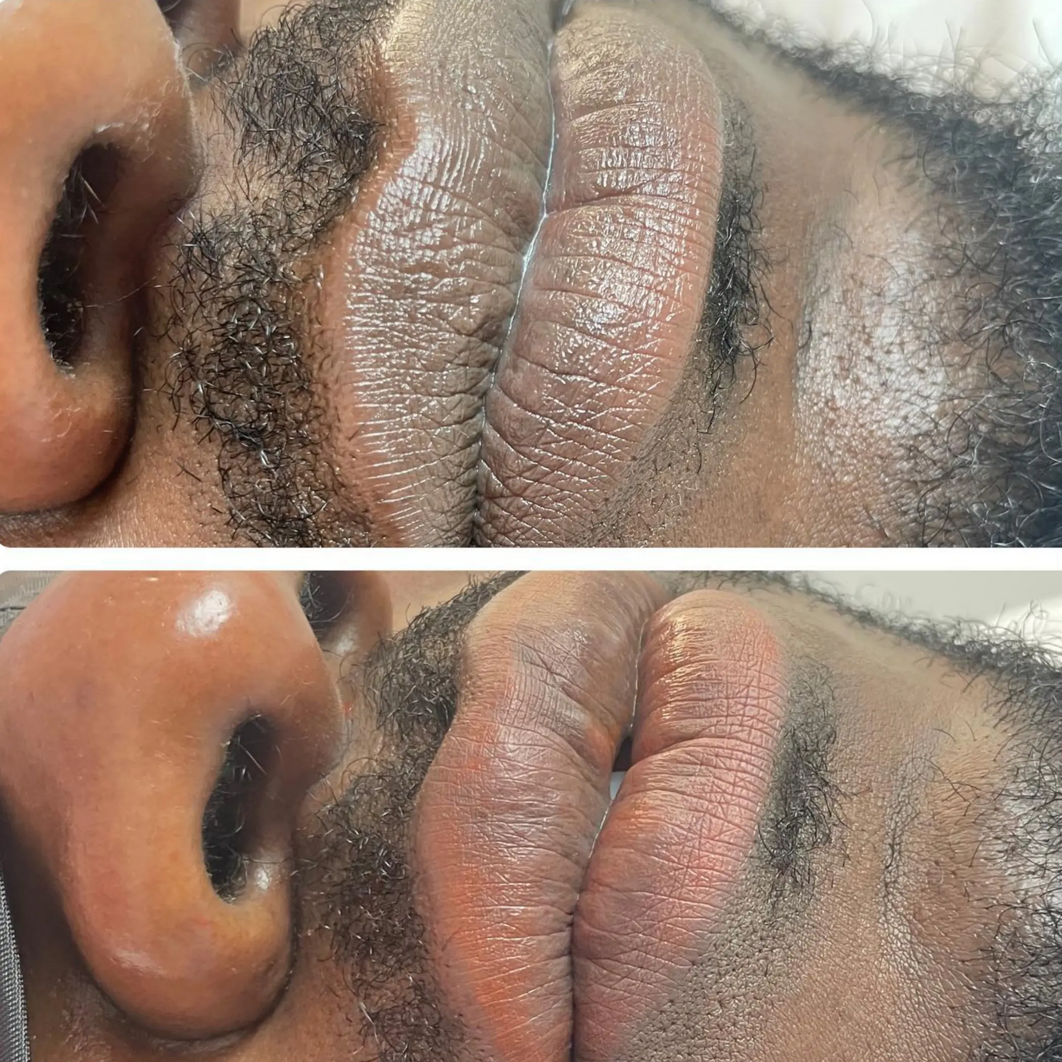 healing stages after lip neutralisation