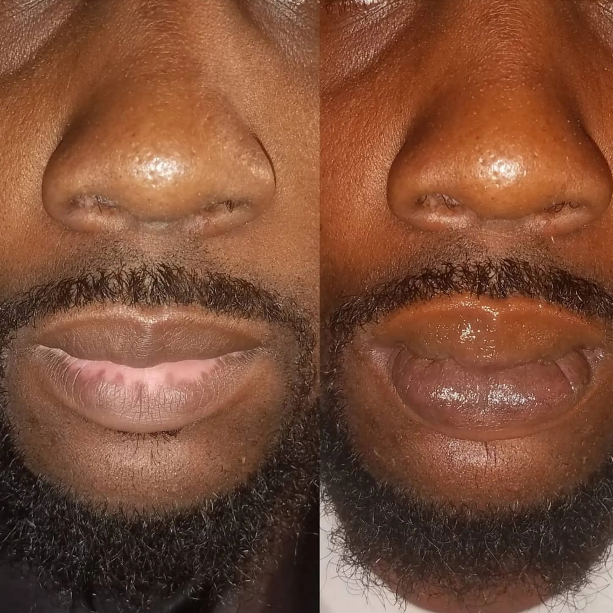 lip neutralisation procedure melbourne studio