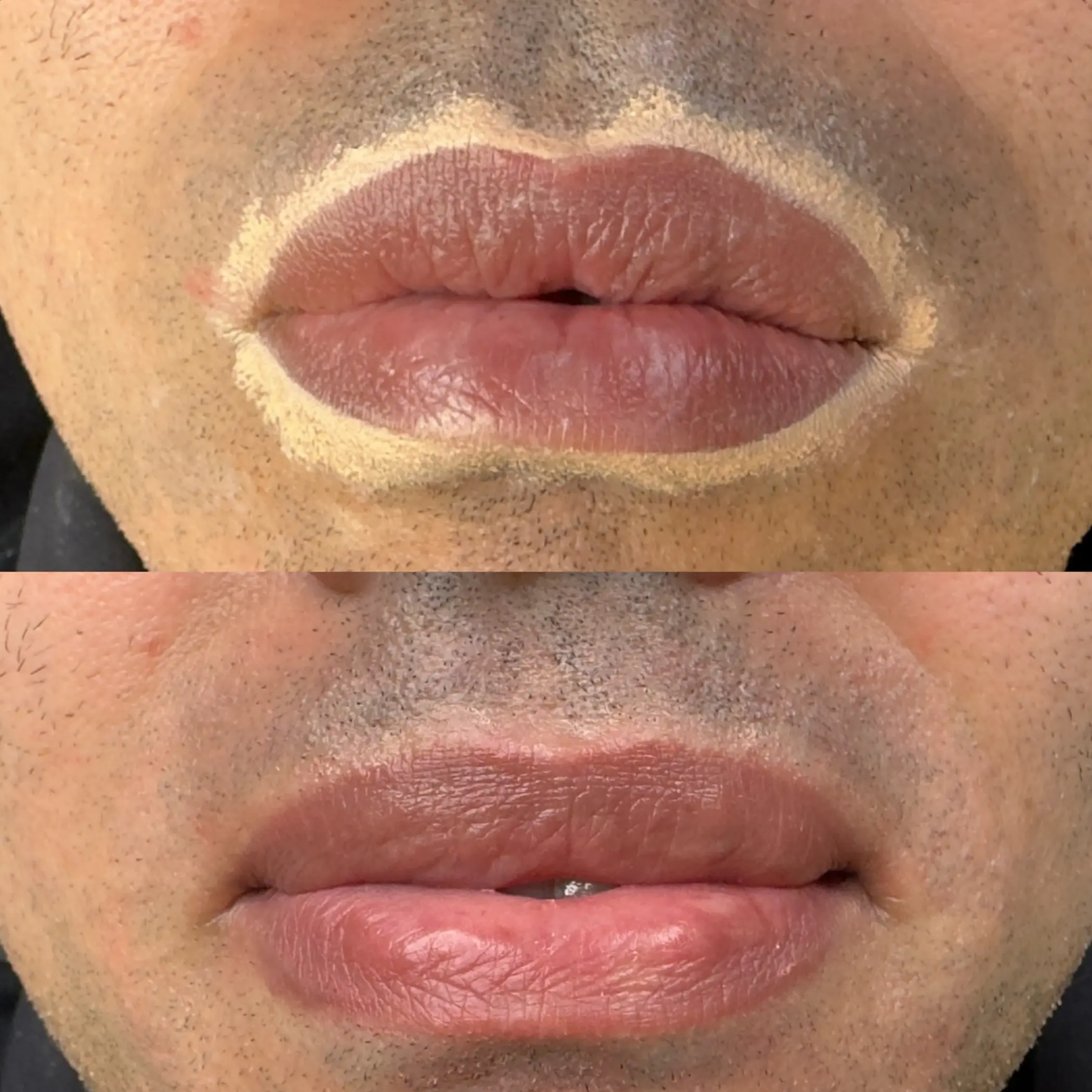 lip tattoo procedure step by step