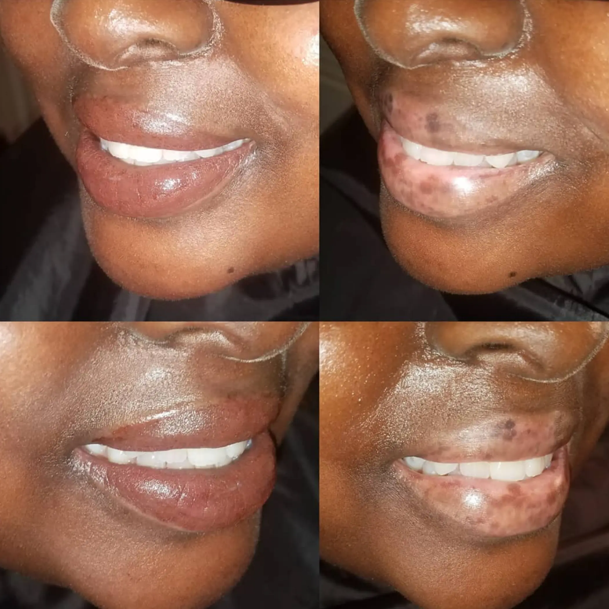 male lip neutralisation before after