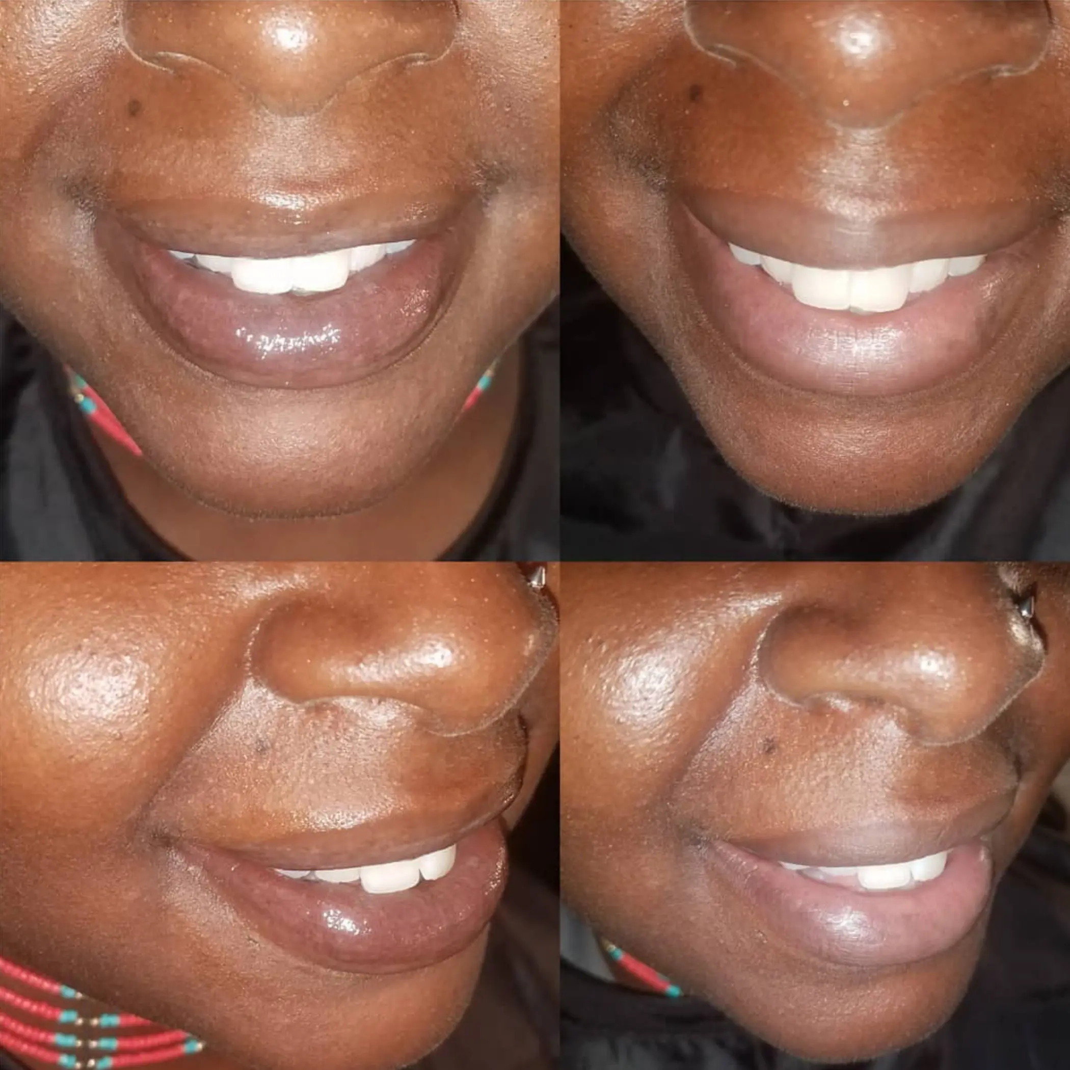 male lip tattoo before after melbourne