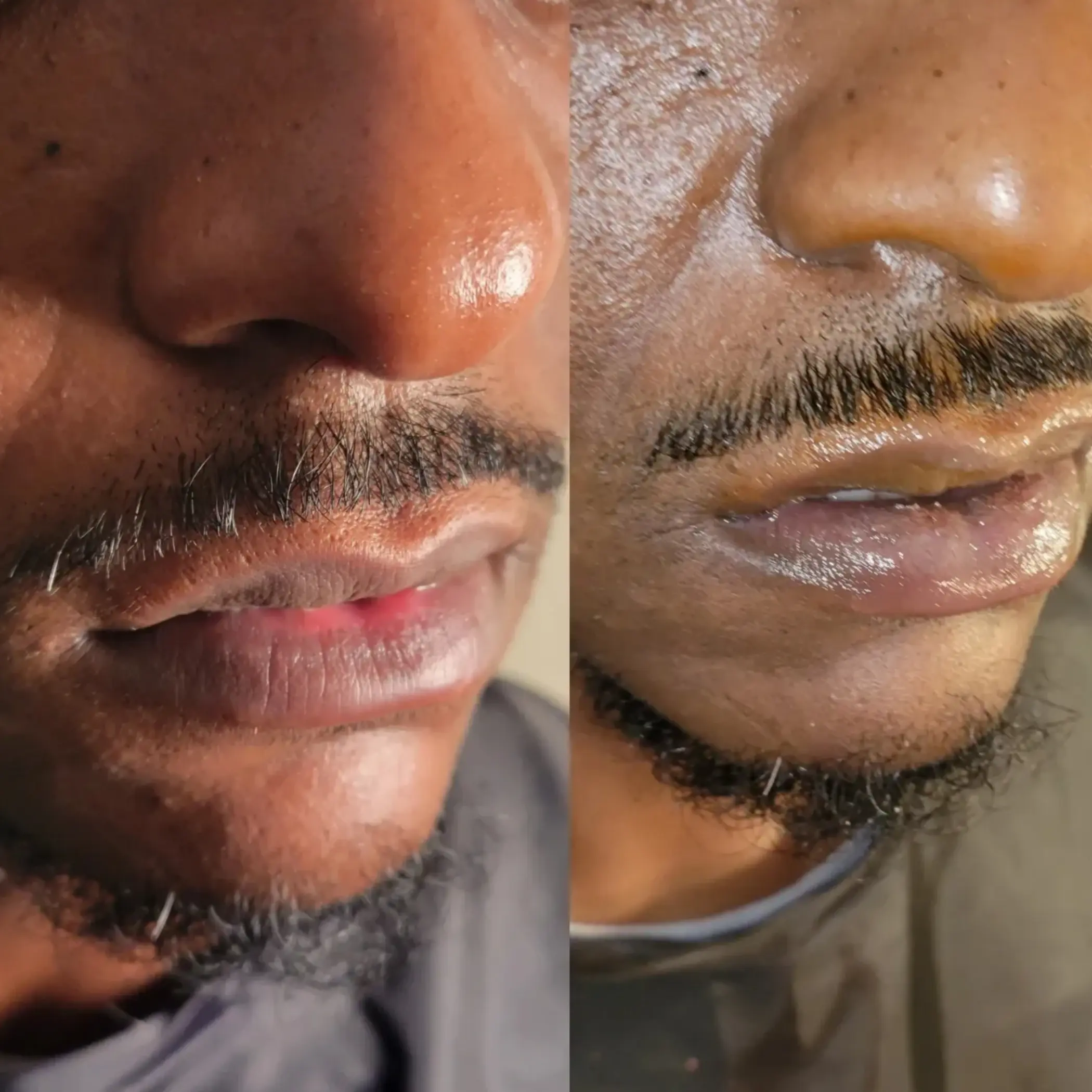 men lip filler before and after photos