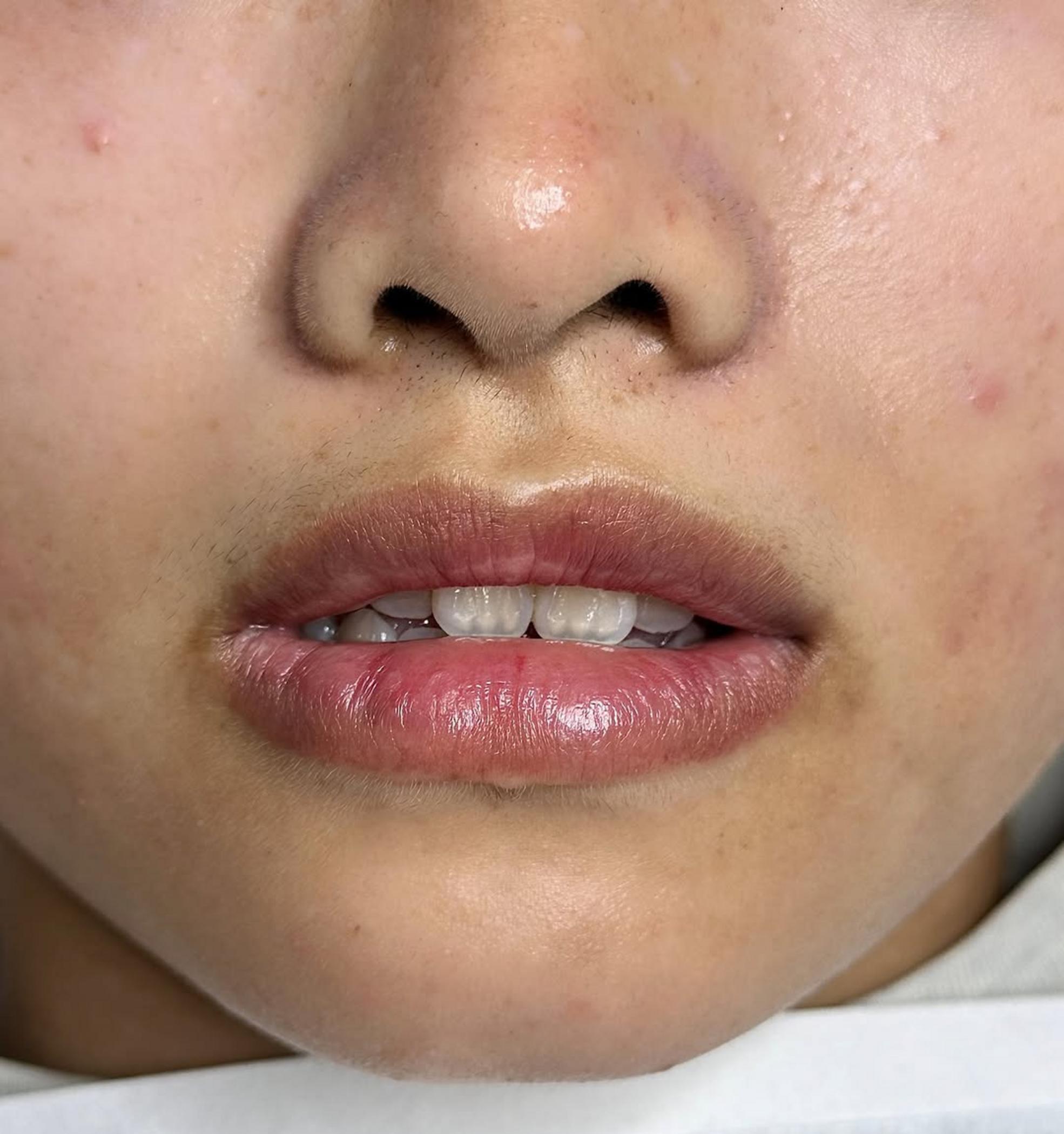 technician performing lip correction treatment