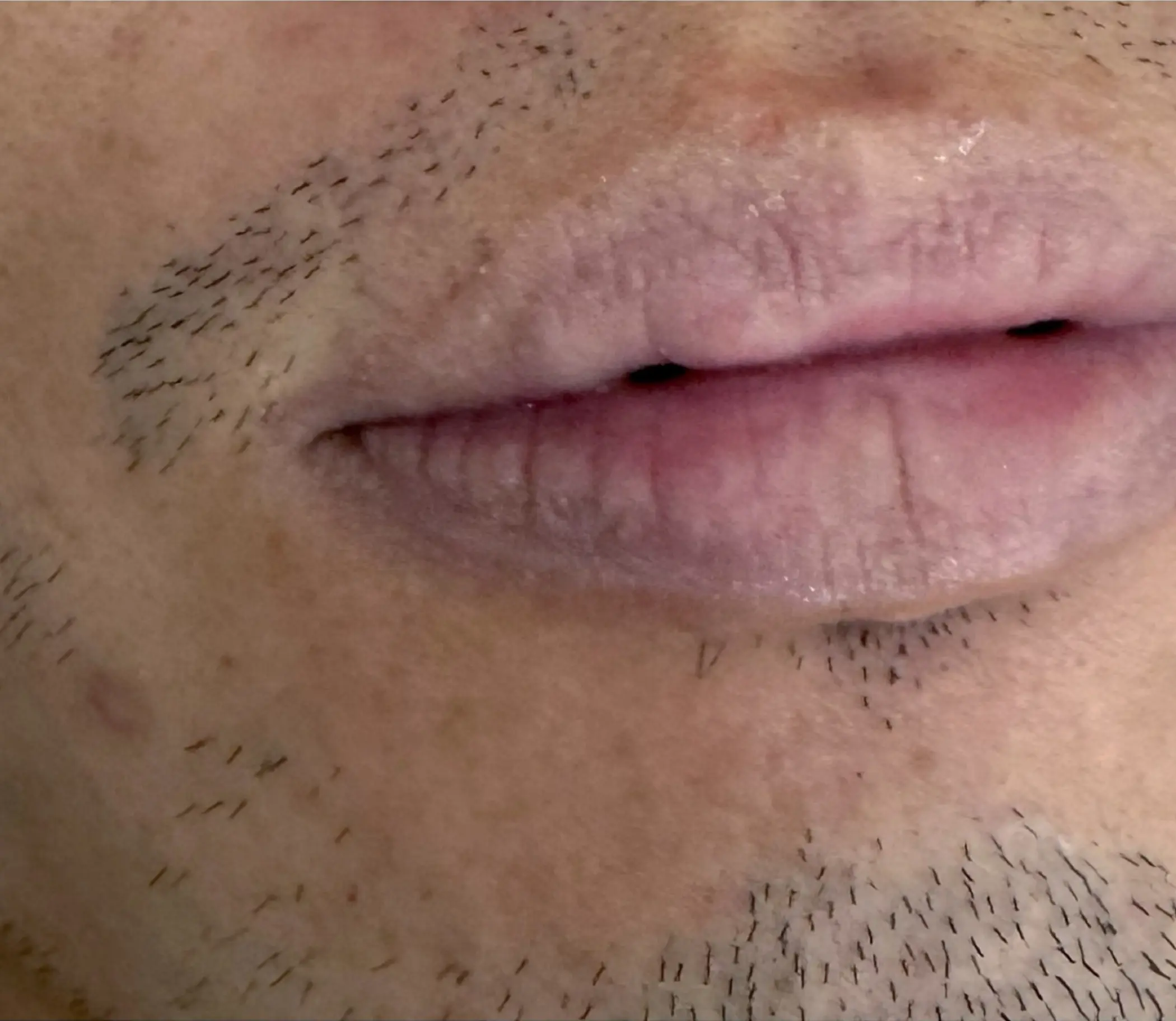 technician performing lip tattoo procedure