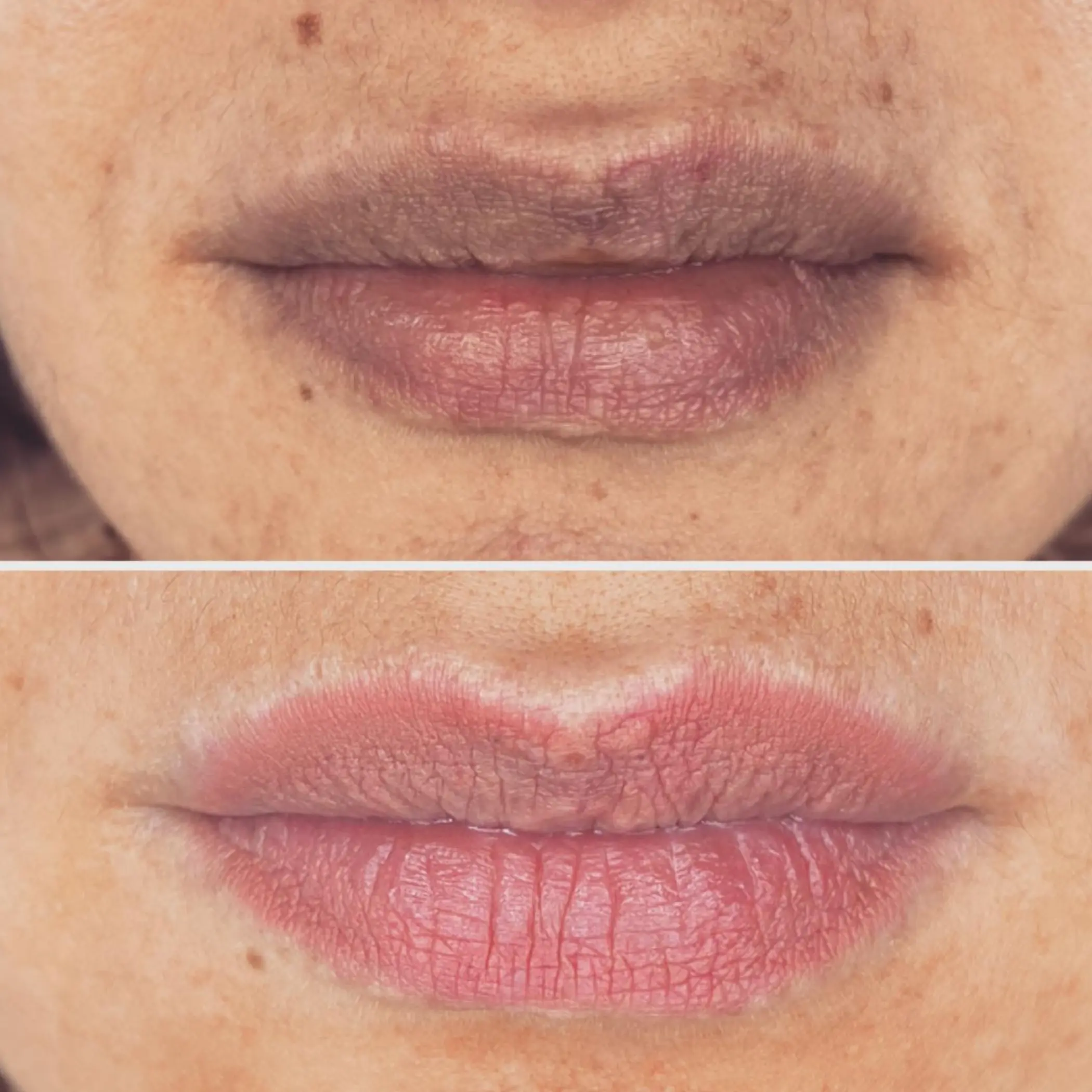 technician performing lip tattoo procedure