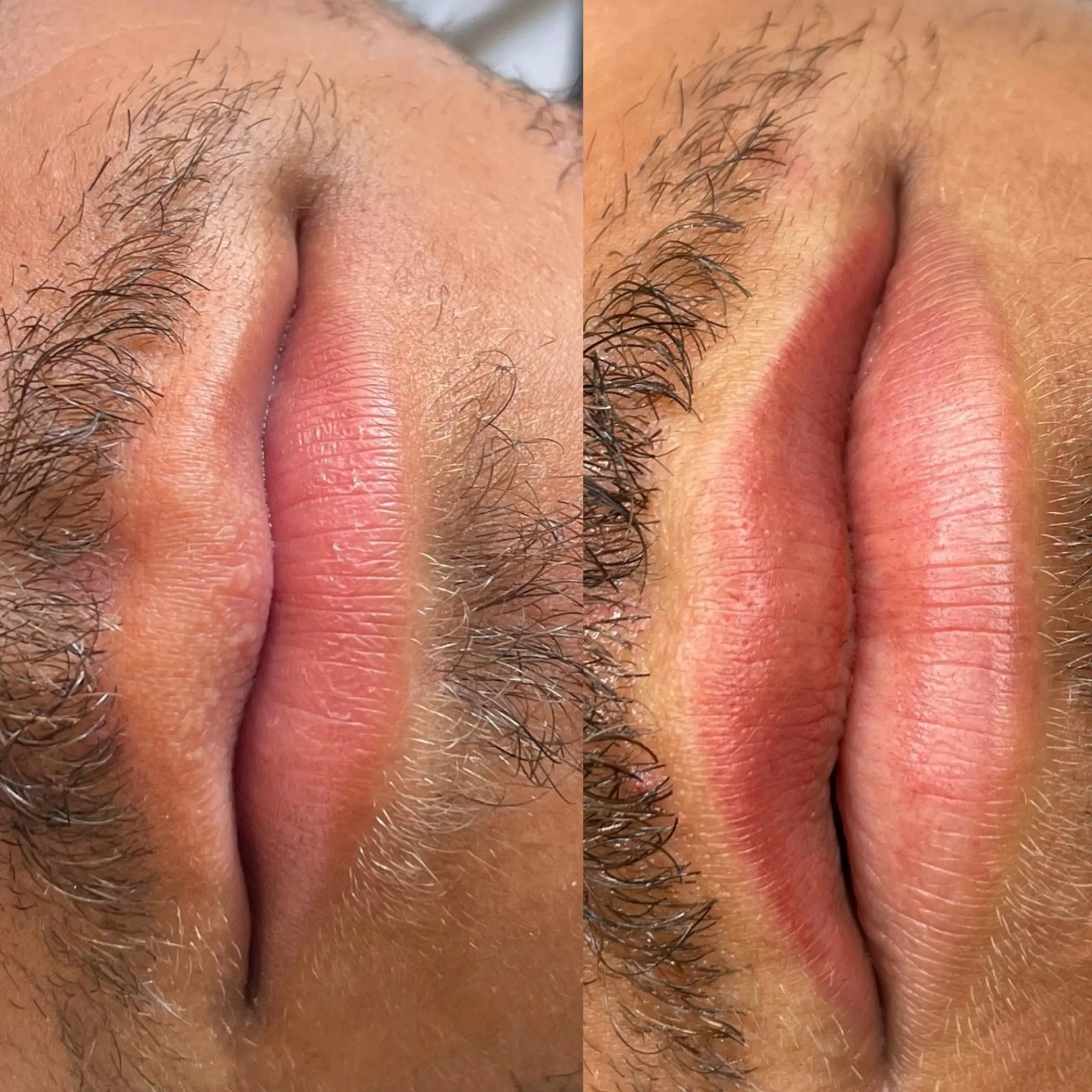 technician performing scalp micropigmentation procedure